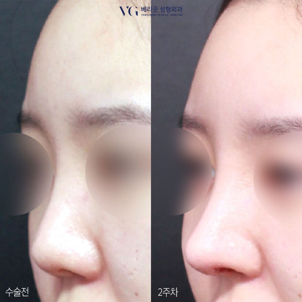 직반코성형? 베리굿성형외과💙 화려하게,자연스럽게✨ 관련 이미지 6