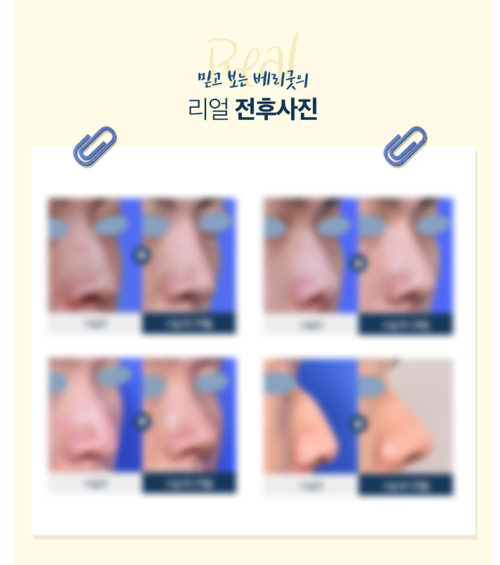 남자코성형 알아본다면, 기억하세요~ 베리굿성형외과! 관련 이미지 8