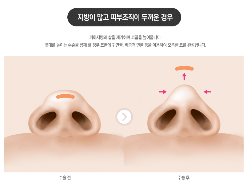 주먹코 큰코 복코!! 베리굿성형외과에서 복코 교정하자 관련 이미지 5