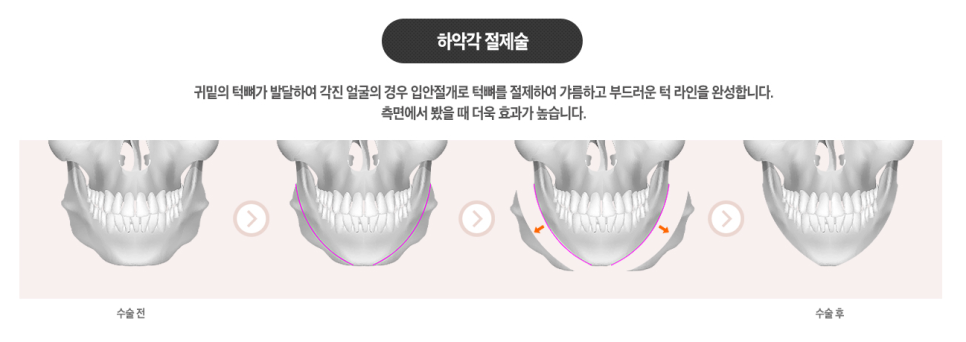 안면윤곽 3D-CT로 뼈구조부터 확인하고 관련 이미지 2