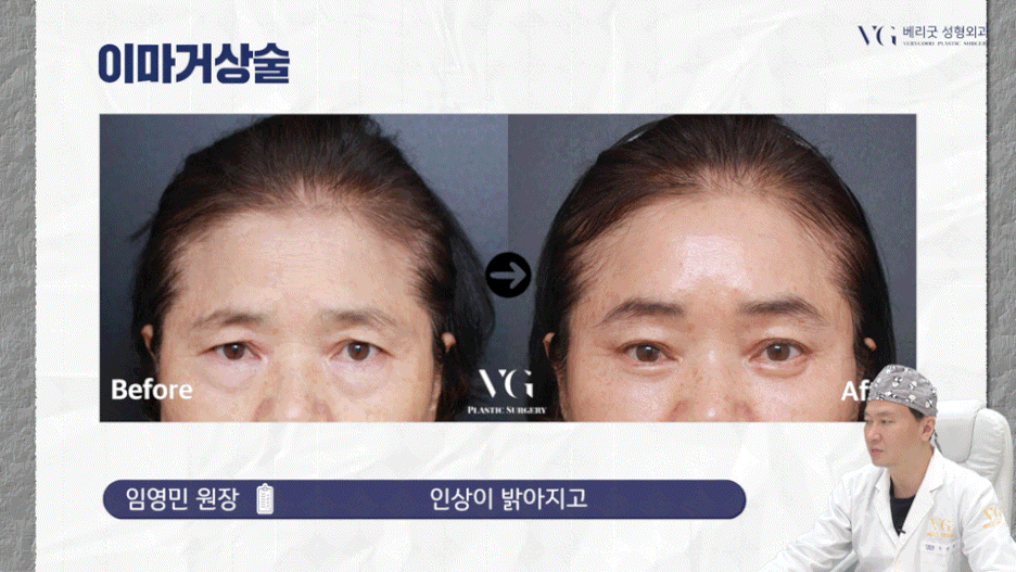 강남중년눈성형 잘하는곳 , 상안검 하안검 눈썹하거상술종류 진행방법 궁금하다면 관련 이미지 40