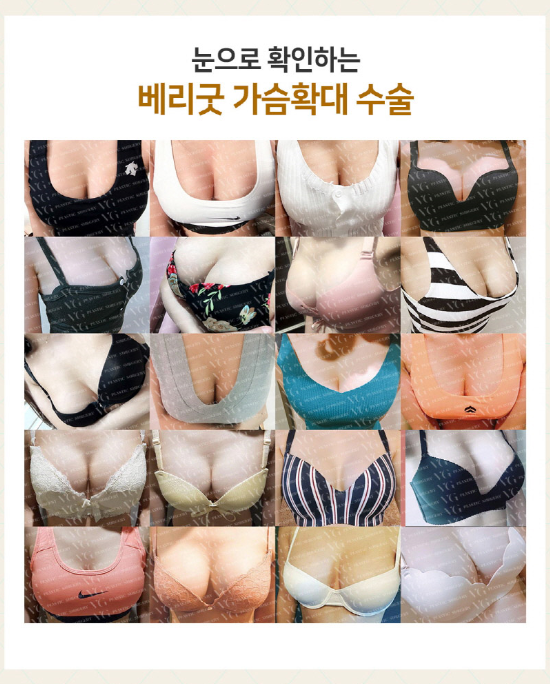 부드러운 촉감에 자연스러운 가슴성형을 찾는다면 베리굿성형외과로! 관련 이미지 11