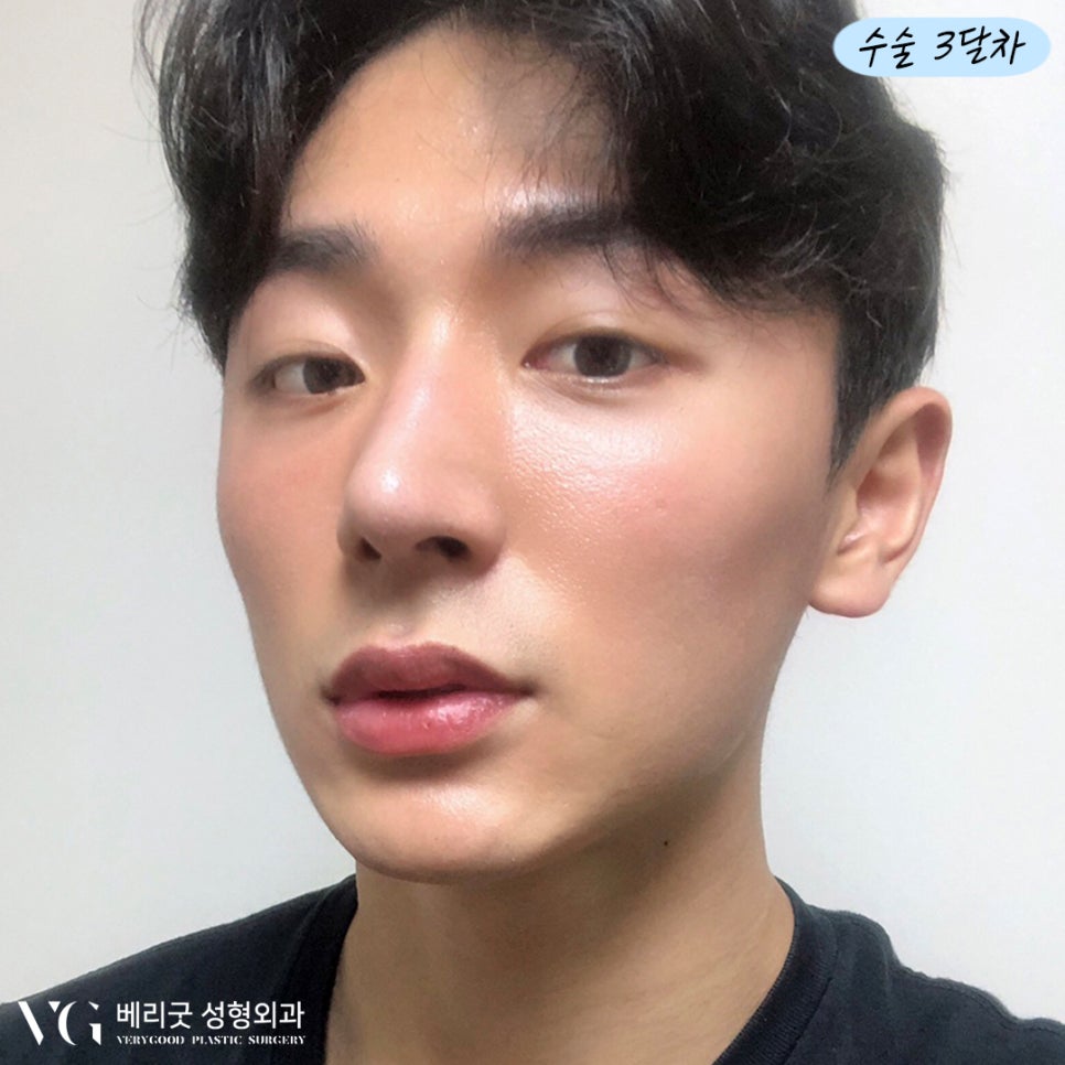 남자코 성형 다~ 모였다! 베리굿성형외과💙 관련 이미지 5