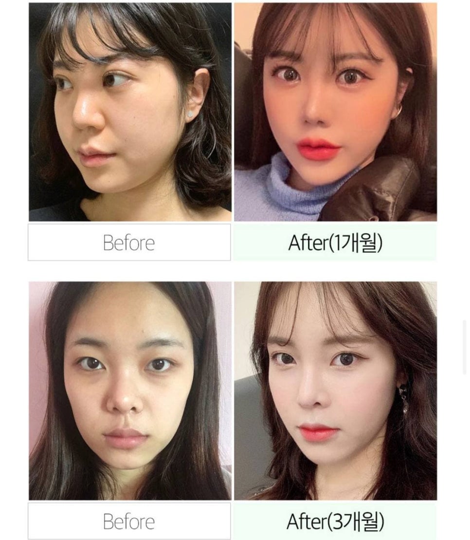 풀페이스 지방이식,지방이식 가격 알아보자 관련 이미지 6
