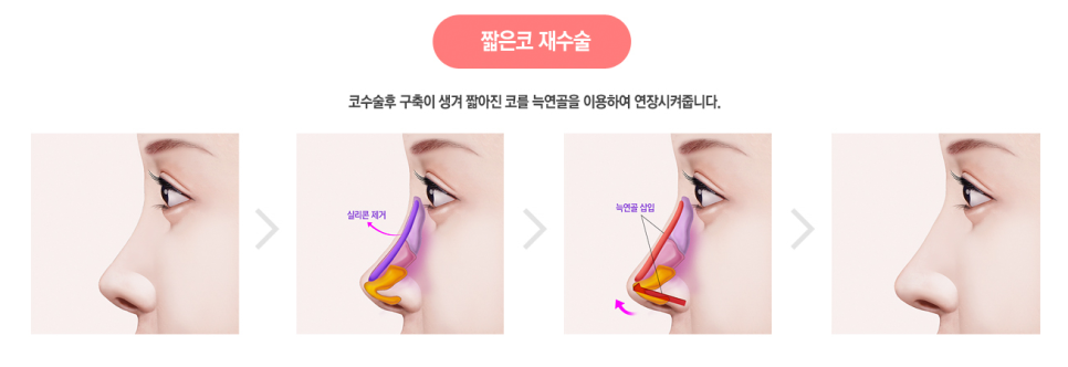 자가 늑연골 코재수술로 완벽해지자! 관련 이미지 4