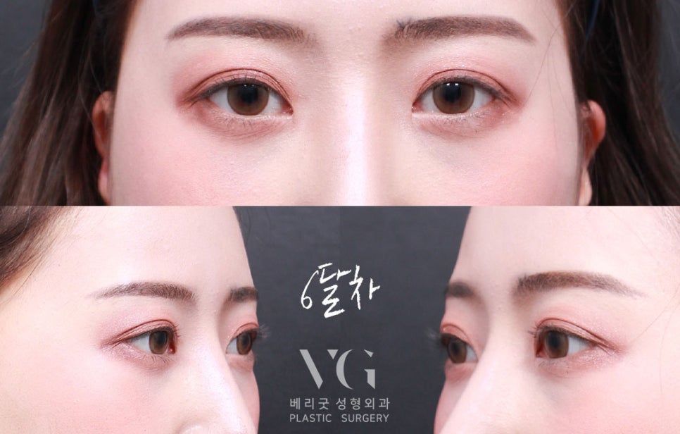 다크서클 없애는 눈밑지방재배치(눈밑지)베리굿성형외과 전후✨ 관련 이미지 7