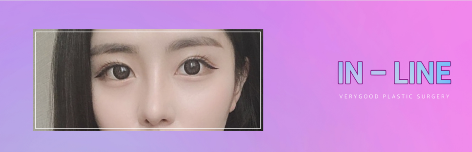 베리굿 눈매교정으로 졸려보이는 안검하수 탈출~! 관련 이미지 3