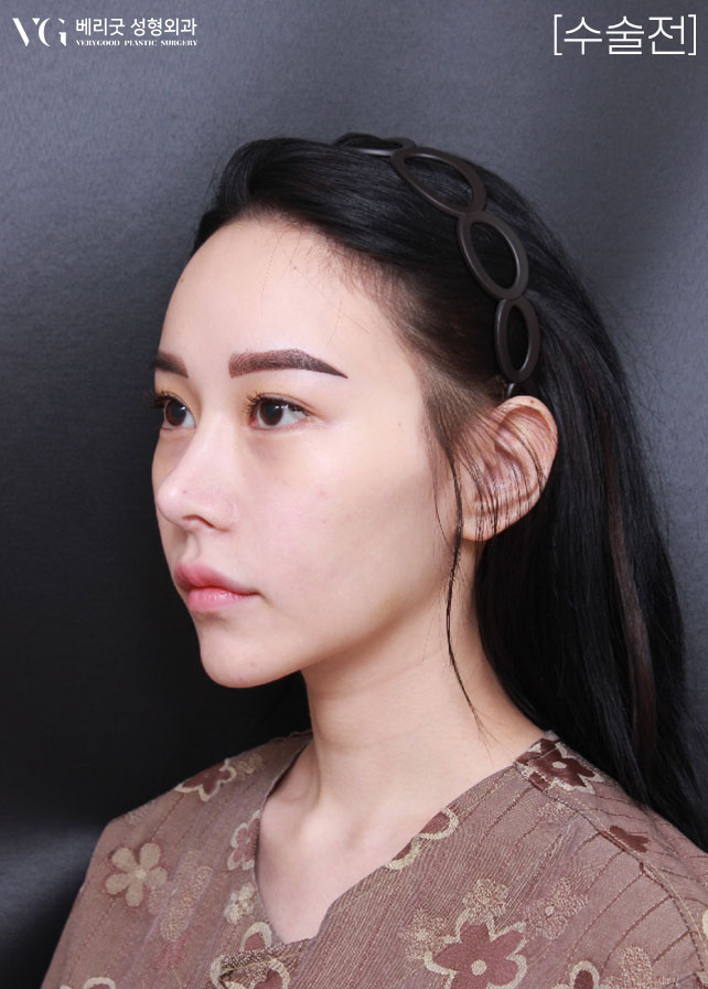 [베리굿성형외과]안면윤곽 리얼전후! 관련 이미지 3