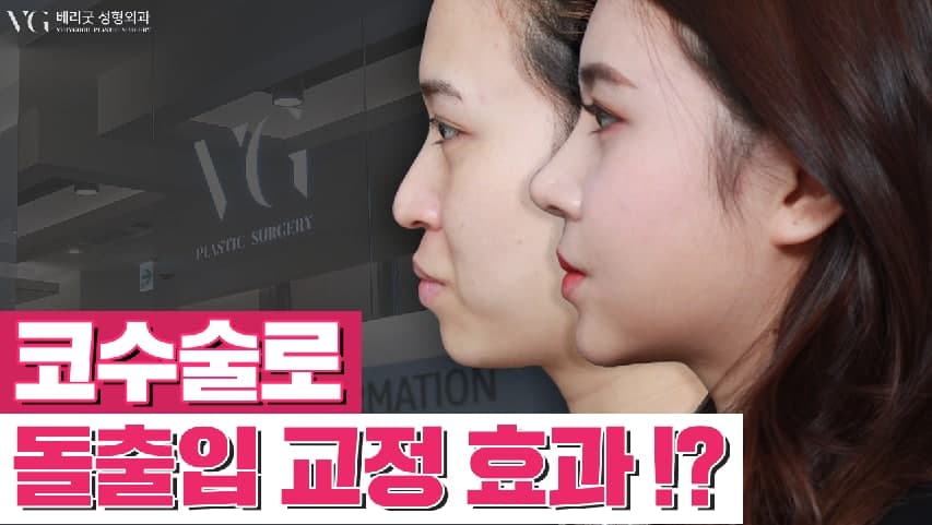교정 없이! 발치 없이! 코성형으로 돌출입교정하자 ❤베리굿성형외과❤ 관련 이미지 1