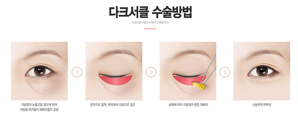 다크서클 없애는 눈밑지방재배치(눈밑지)베리굿성형외과 전후✨ 관련 이미지 5