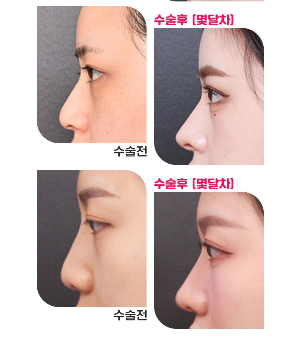 뚱뚱한코, 짧은코, 퍼진코 전부 고민된다면? MZ코가 답이다 관련 이미지 5