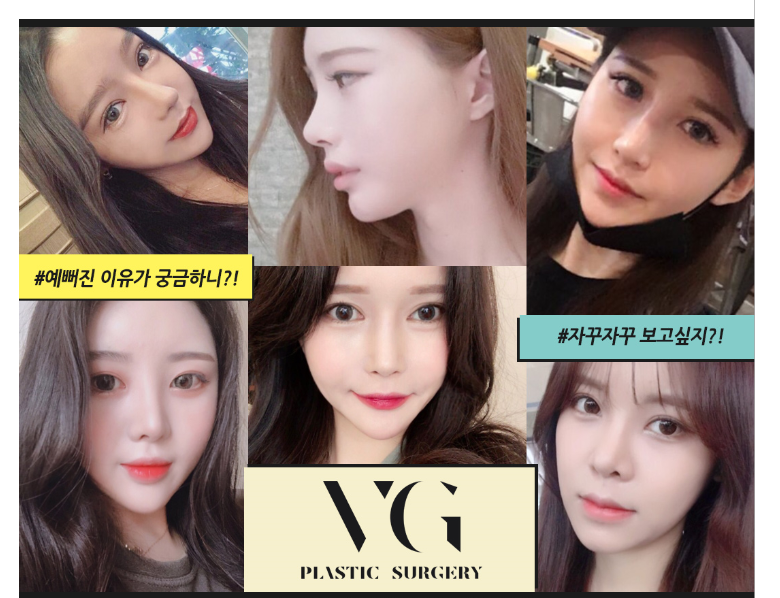 뼈수술 없이 V라인만들기! 베리굿성형외과 얼굴지방흡입 관련 이미지 8