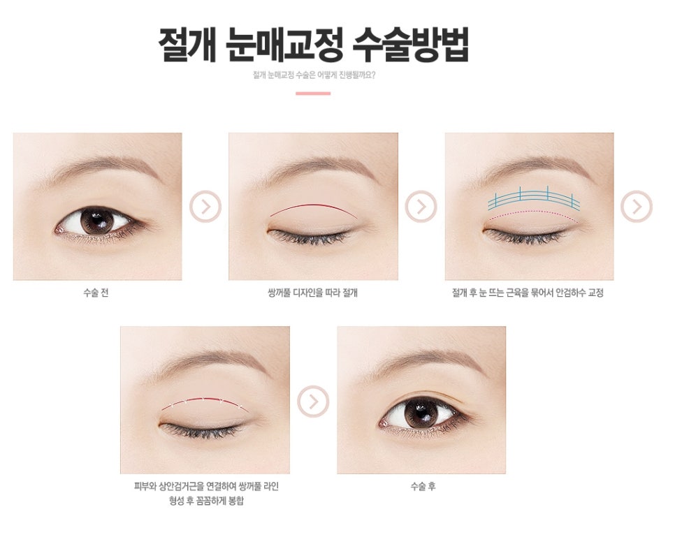 [베리굿성형외과 강남눈매교정]누구나 반하는 또렷한 눈매만들기✨ 관련 이미지 8