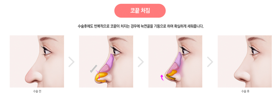 자가 늑연골 코재수술로 완벽해지자! 관련 이미지 2