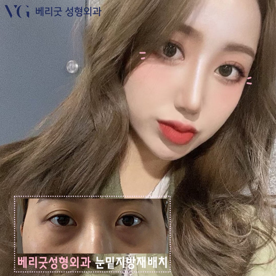 다크서클 없애는 눈밑지방재배치(눈밑지)베리굿성형외과 전후✨ 관련 이미지 1
