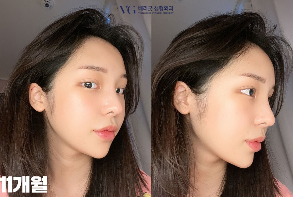 강남역 윤곽성형 베리굿성형외과👨&zwj;⚕️안면윤곽 전문의 임영민대표원장님💖 관련 이미지 10