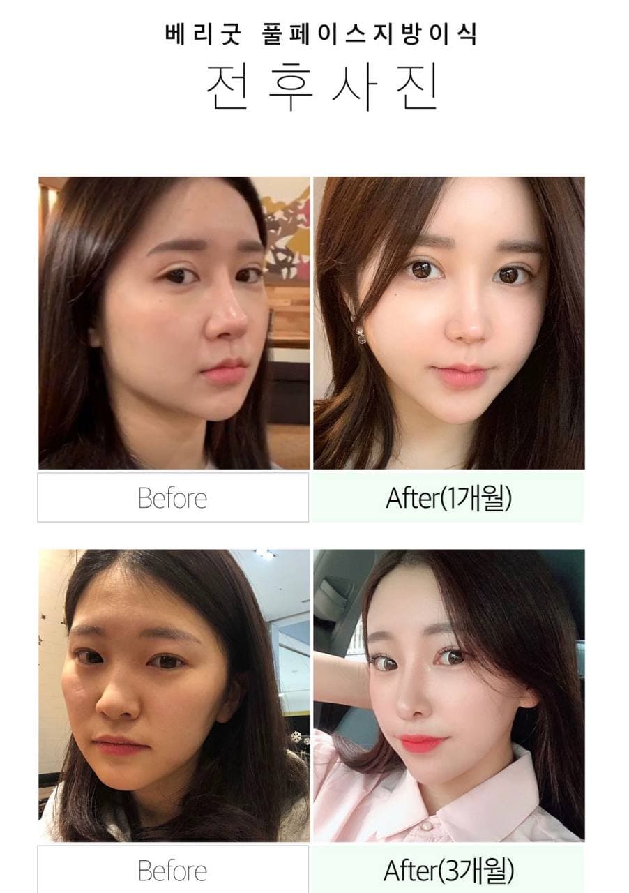 풀페이스 지방이식,지방이식 가격 알아보자 관련 이미지 5