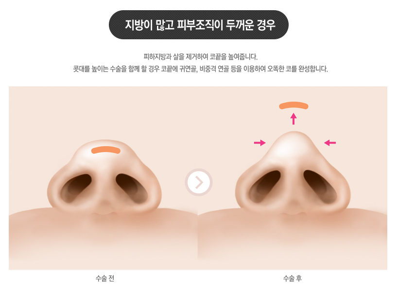 #복코성형 #복코수술 역시😘 #베리굿성형외과 관련 이미지 5