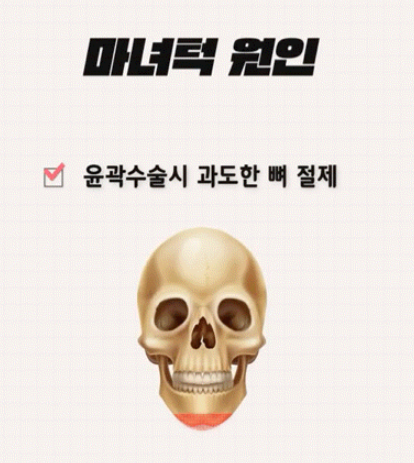 강남역 마녀턱 턱끝거상 , 리프팅원인 수술방법 총정리 관련 이미지 5