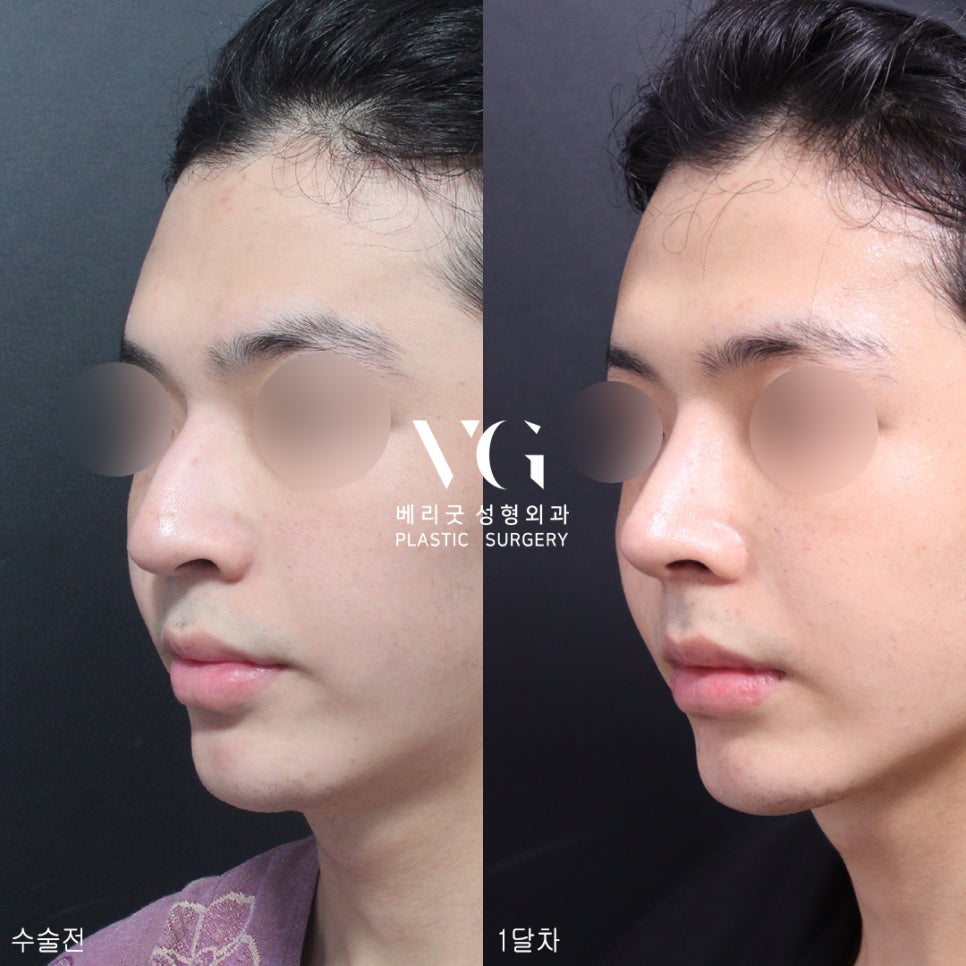 남자코성형전후가 궁금해?남자코성형도 베리굿성형외과💙 관련 이미지 2