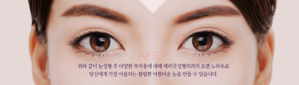 눈재수술, 원인과 상태에 따라 방법도 바뀐다? 관련 이미지 2