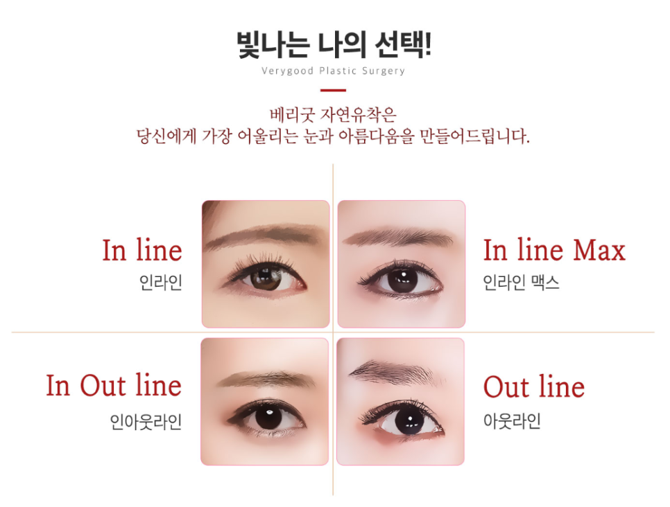 베리굿하게💖베리굿성형외과 눈성형전후 관련 이미지 3