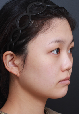 베리굿 토탈 안면윤곽으로 매끄러운 얼굴라인 완성! 관련 이미지 2