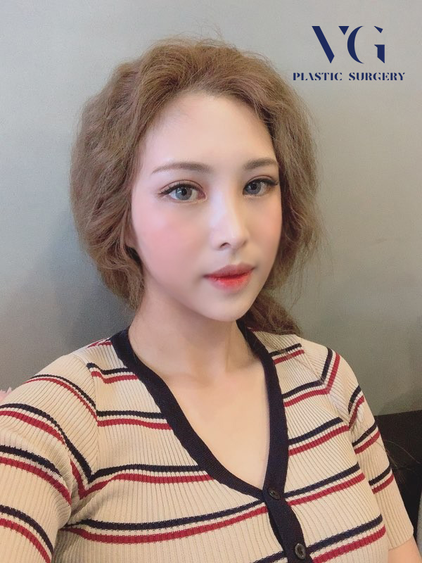 눈재수술 만족스러운 결과를 위해서는 관련 이미지 1