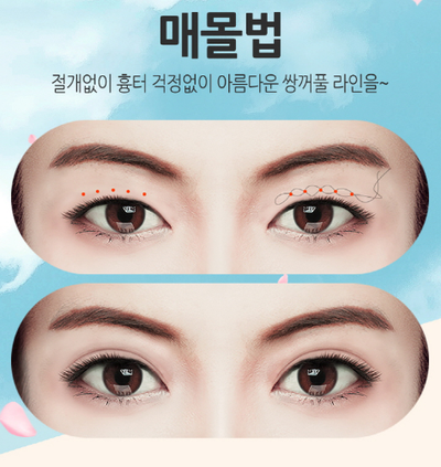 눈성형잘하는곳 잘고르는법 관련 이미지 3