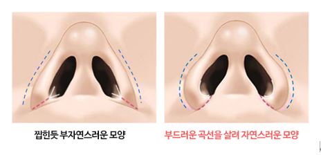 How Can Wide Nostrils Be Corrected? (Effective Bulbous Nose Correction Methods) image 4