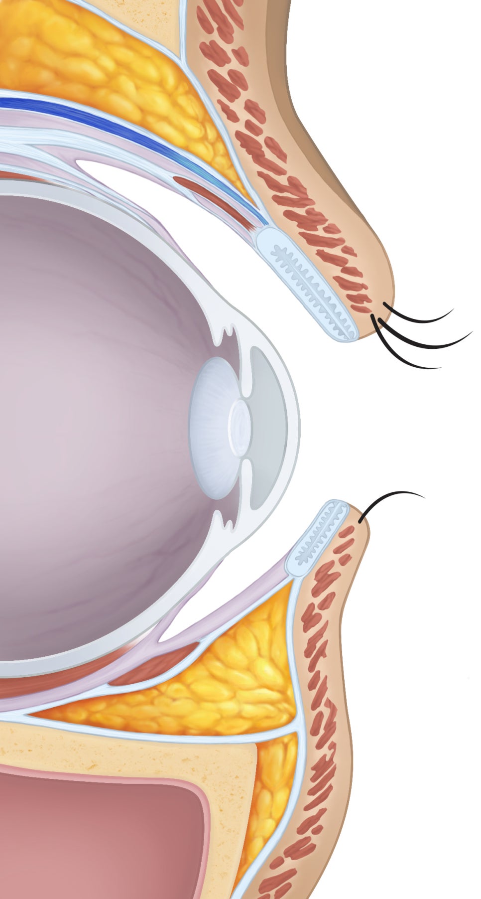 Revision Eye Surgery: Is Correction of Upper Eyelid Retraction in Excessively Open Eyes Really Necessary? image 3