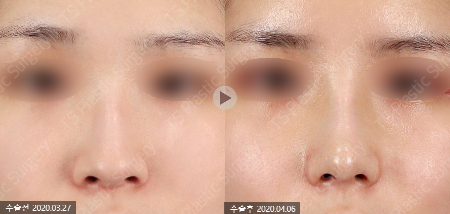 How Can Wide Nostrils Be Corrected? (Effective Bulbous Nose Correction Methods) image 5