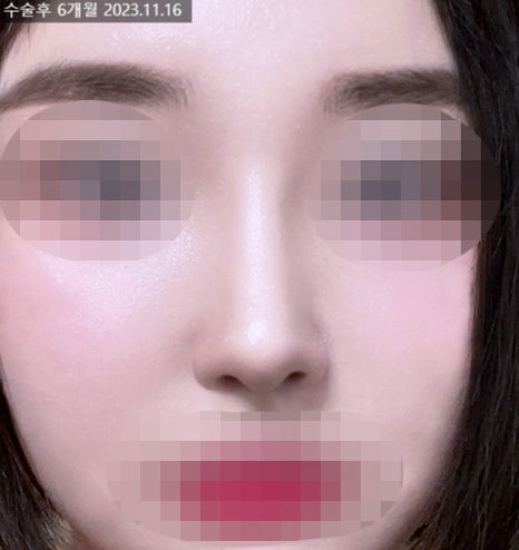 If hump nose surgery and alar reduction are performed together, it may help achieve harmonious facial proportions image 6