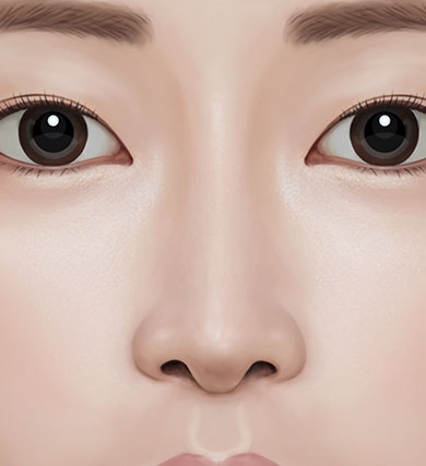 [코수술 리뷰] 낮고 코끝이 들린 짧은코성형 케이스 리뷰 관련 이미지 3