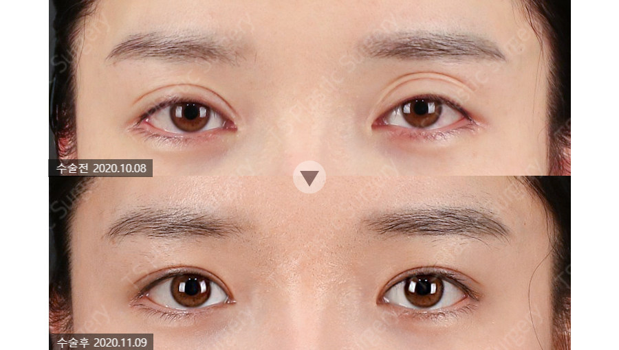 Can the Line Be Changed Because of an Epicanthoplasty Scar? How to Change It to an Outlined, Inline, or In-Out Line image 5