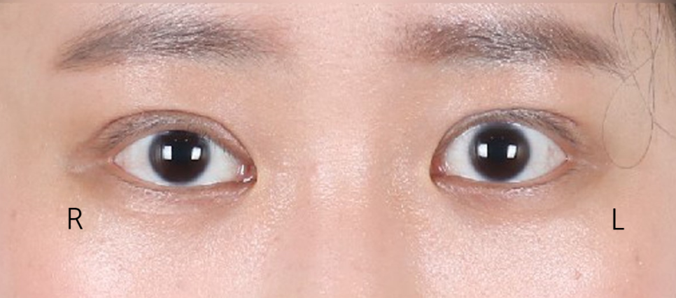Revision Eyelid Surgery Review (3) Extreme Eyes, Cases of Improvement After Overcorrection in Eyelid Correction image 3