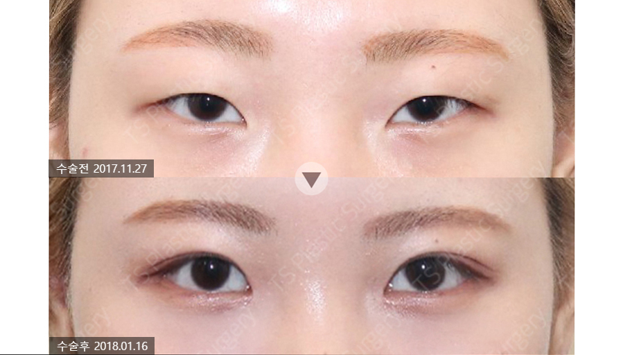 How Can You Avoid Needing Revision Surgery After Double Eyelid Surgery? image 2