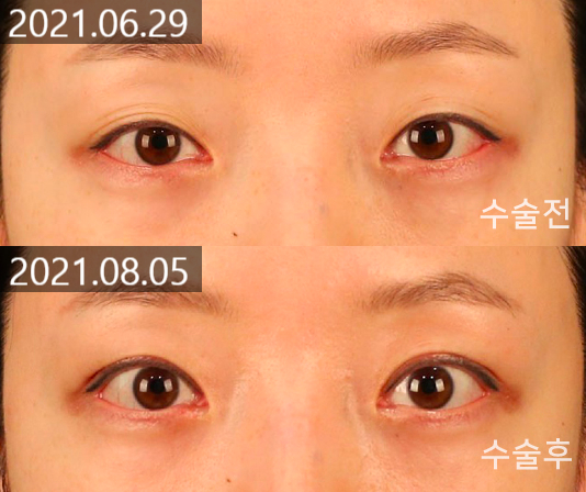Changes and Causes That Can Occur When the Double Eyelid Line Becomes Weaker image 7