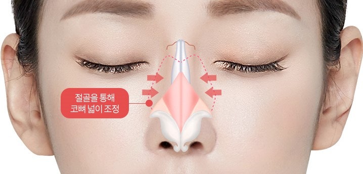 Hump Nose: In What Cases Is Osteotomy Needed? image 4