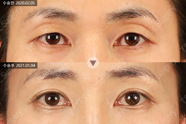 꺼진 눈과 겹주름, 눈두덩이 지방이식 시 주의할 점은? 관련 이미지 1