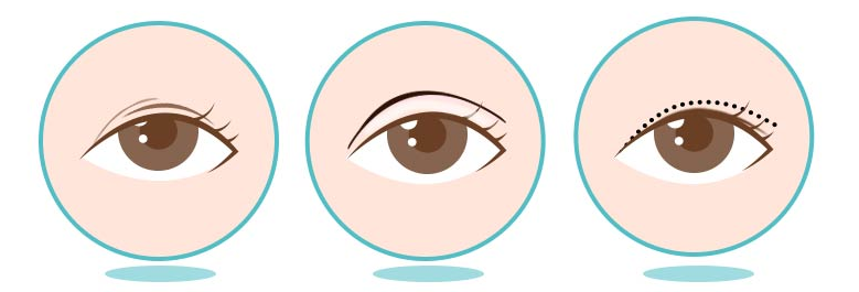 Important Points to Consider When Thinking About Revision Surgery After Eye Surgery image 1