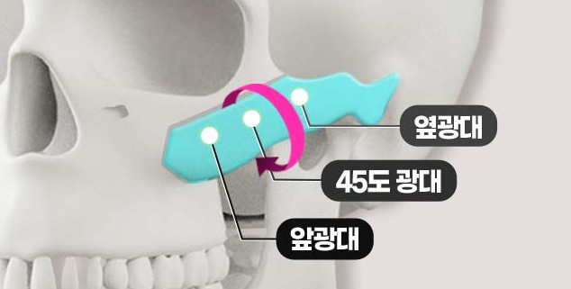자연스러운 얼굴 라인을 위한 안전한 얼굴 윤곽 개선 방법 관련 이미지 2