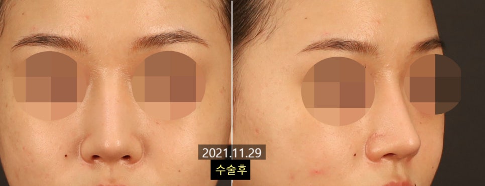 코수술 후 변화가 뚜렷하게 느껴지는 얼굴 유형 4가지 관련 이미지 2