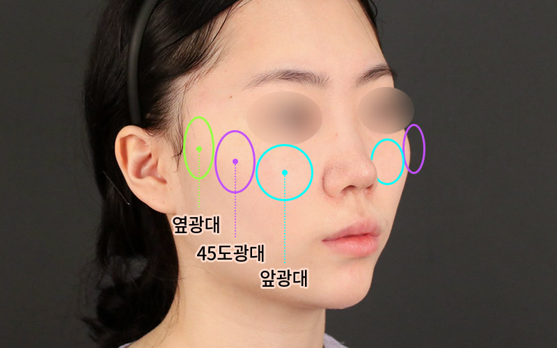 Does Facial Contouring Surgery Always Require All 3 Procedures? Cases Where Zygoma Reduction Surgery Alone Can Create a Smaller, Smoother Face image 3