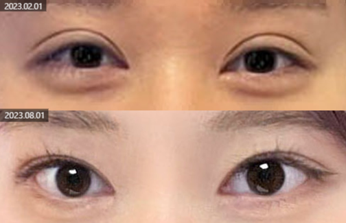 눈매교정으로 보다 선명한 눈매 만들기, 고려할 점은? 관련 이미지 3