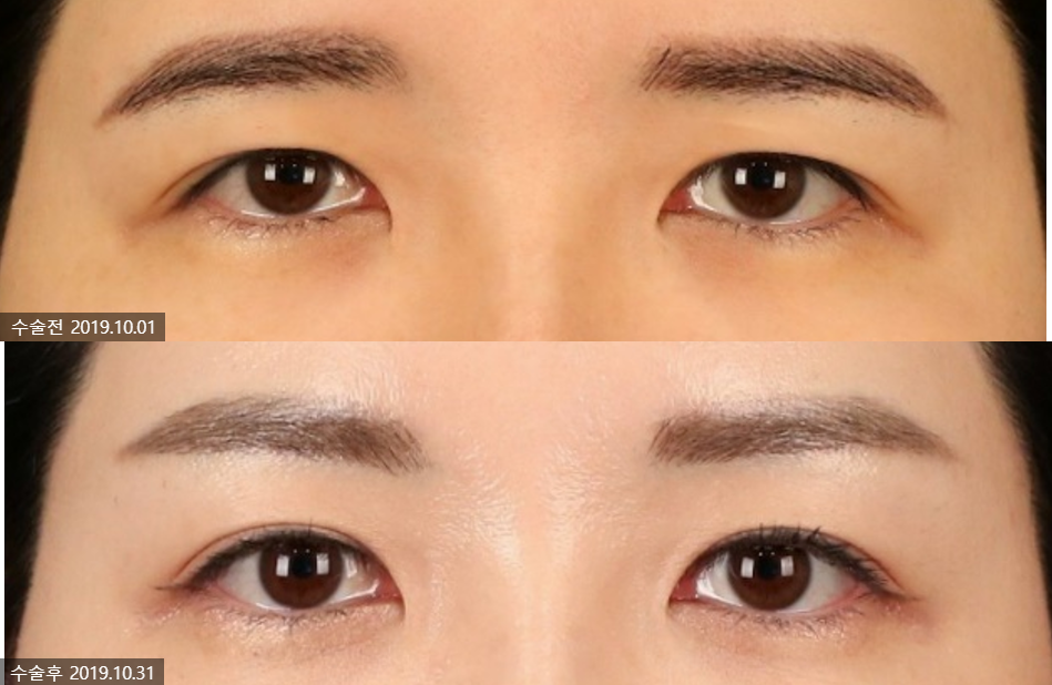 20~30대 이마리프팅 왜 필요할까? 관련 이미지 5