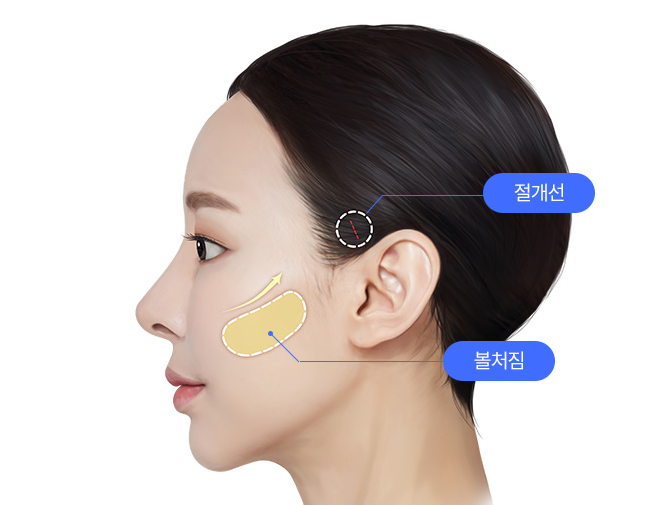 안면거상술이 필요한 경우는? 얼굴거상술이 도움이 될 수 있는 경우를 알아보세요! 관련 이미지 3