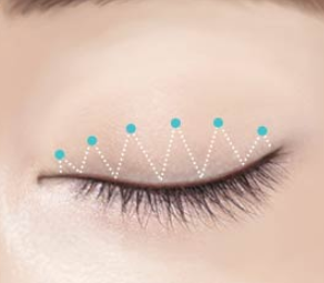 What Should You Check Before Undergoing a Non-Incisional Double Eyelid Surgery? image 5