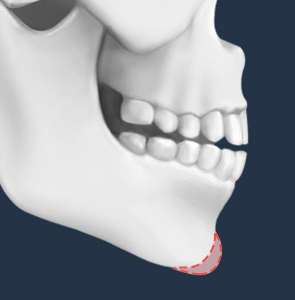 It Is Important to Perform Chin Augmentation with a Chin Implant by Considering Individual Facial Proportions image 1
