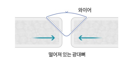 윤곽수술(광대축소수술, 사각턱수술) 후 볼처짐, 살처짐은 걱정해야 하는 부분일까? 관련 이미지 6